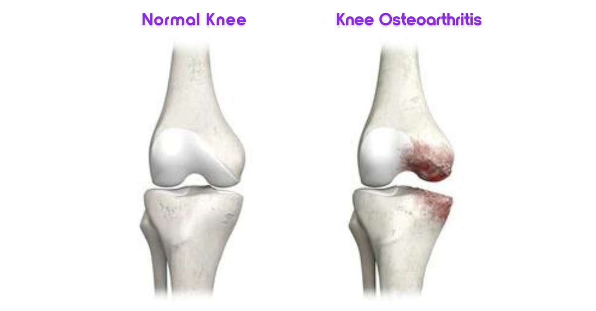 Normal Bone vs an Arthritic Bone